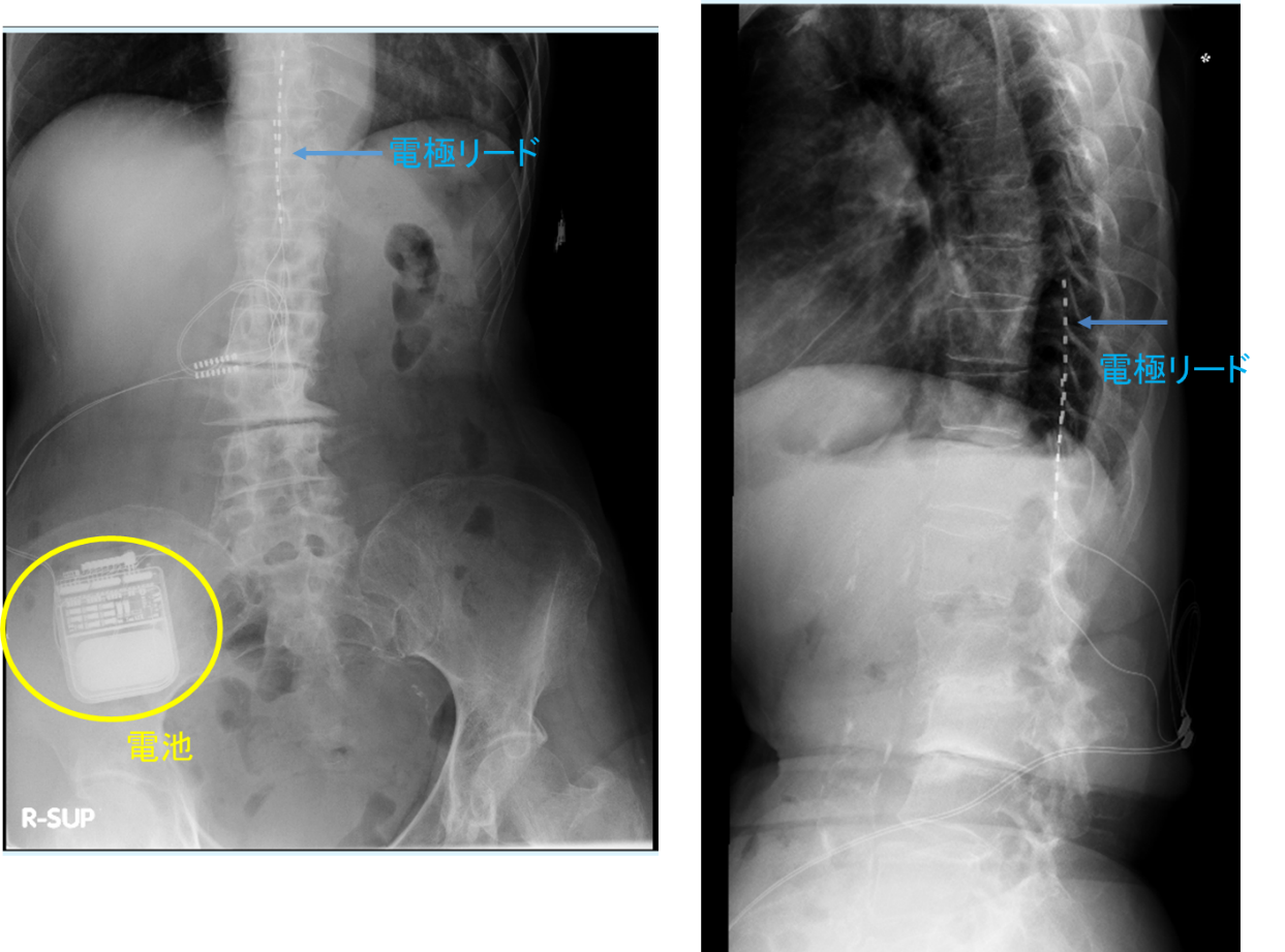 図2_脊髄刺激装置植え込み術